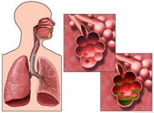 阻塞性肺气肿的症状是什么 如何治疗好呢