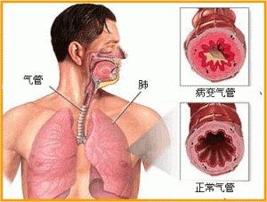 治疗气管炎的雾化药物有哪些 具体用法是怎样的