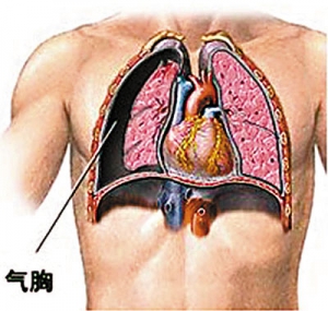 气胸怎么治疗 方法是什么